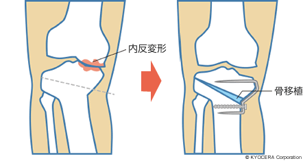 高位脛骨骨切り術