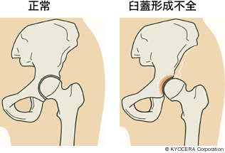 正常 臼蓋形成不全