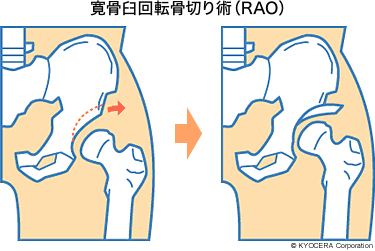 寛骨臼回転骨切り術（RAO）