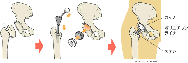 人工股関節置換術