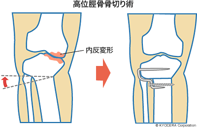 高位脛骨骨切り術