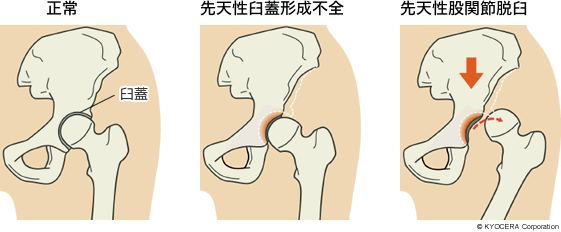 正常、先天性臼蓋形成不全、先天性股関節脱臼