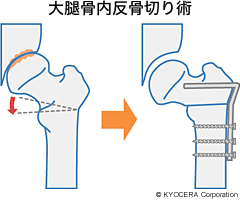 大腿骨内反骨切り術