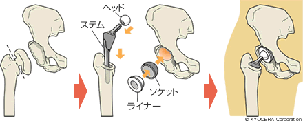 人工股関節 イラスト