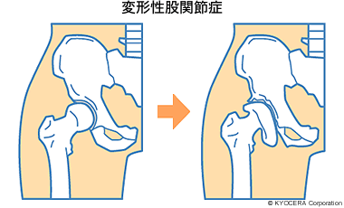 変形性股関節症