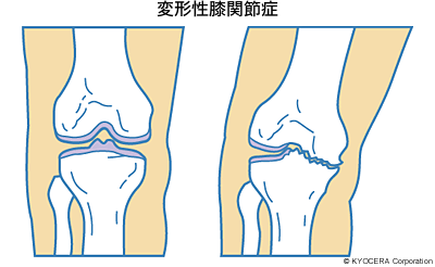 変形性膝関節症