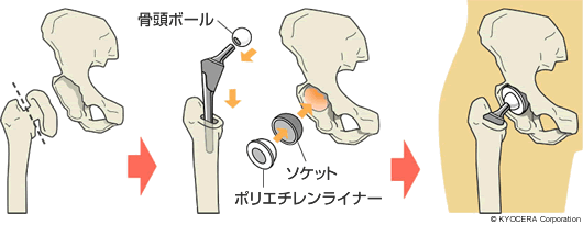 人工股関節 イラスト