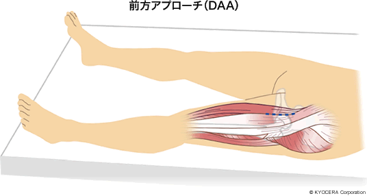 前方アプローチ（DAA）