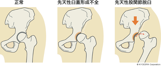 正常、先天性臼蓋形成不全、先天性股関節脱臼