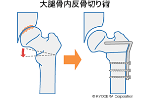 大腿骨内反骨切り術