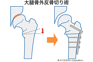 大腿骨外反骨切り術