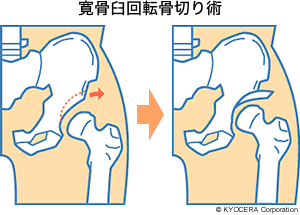 寛骨臼回転骨切り術