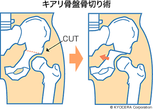 キアリ骨盤骨切り術