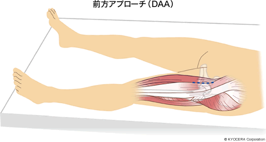 前方アプローチ（DAA）