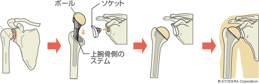 人工肩関節全置換術