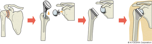 人工肩関節全置換術（リバース型）