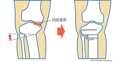 高位脛骨骨切り術