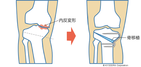 高位脛骨骨切り術