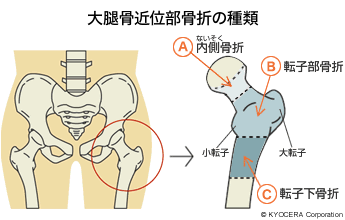 大腿骨近位部骨折の種類