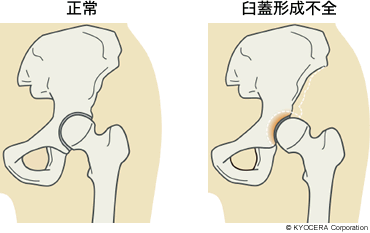 正常、臼蓋形成不全