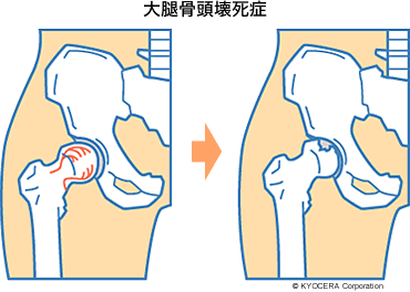 大腿骨頭壊死症