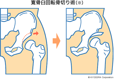 寛骨臼回転骨切り術