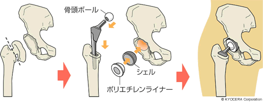 人工股関節全置換術