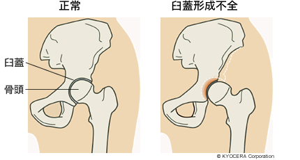 正常、臼蓋形成不全