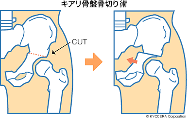 キアリ骨盤骨切り術