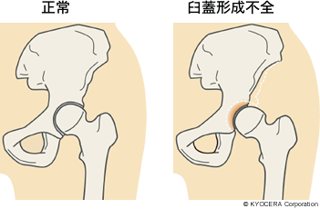 正常、臼蓋形成不全