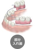 部分入れ歯