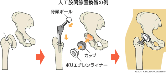 人工股関節置換術の例