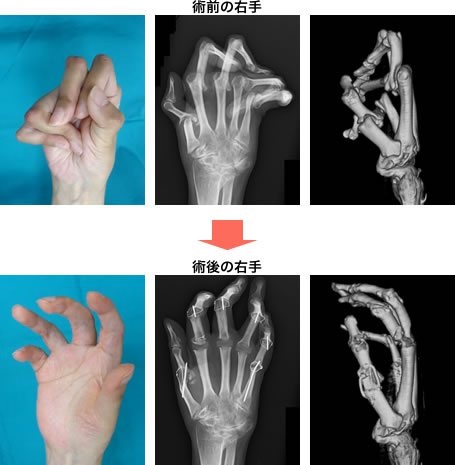 上：術前の右手　下：術後の右手