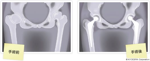 両人工股関節置換術の術前術後の様子