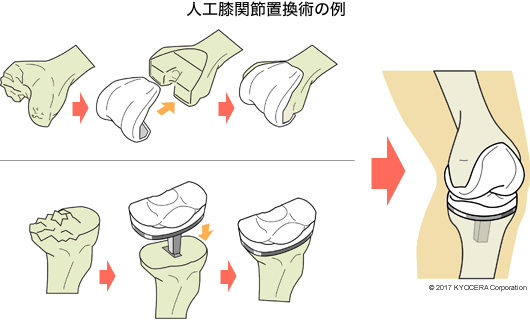 人工膝関節置換術の例