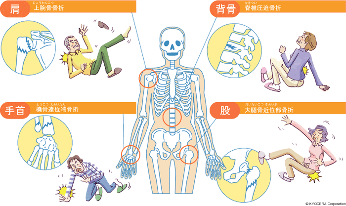 お年寄りの骨折について