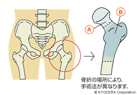 大腿骨近位部骨折とその手術