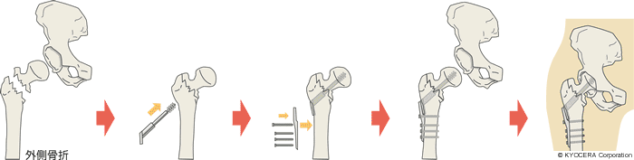 CHS固定法(CHS:Compression Hip Screw)