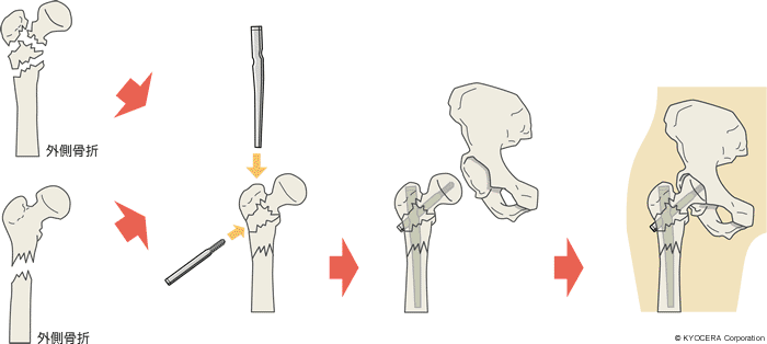 髄内固定法(PFN:Proximal Femoral Nail)