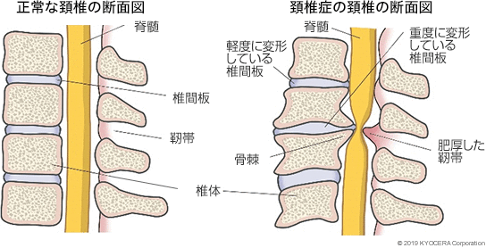 正常な頚椎の断面図 頚椎症の頚椎の断面図