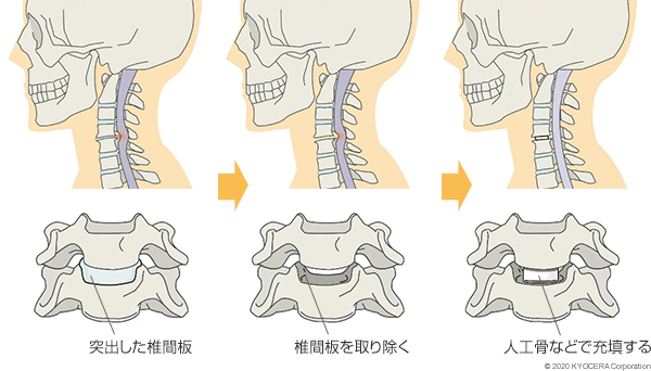 頚椎前方除圧固定術