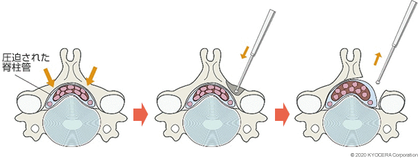 頚椎椎弓形成術 片開き法