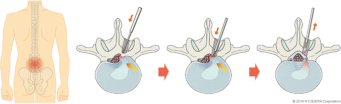 腰椎椎間板切除術 片開き法