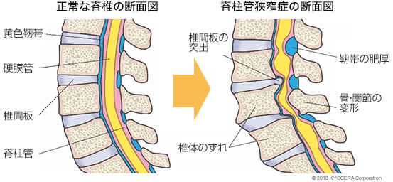 正常な脊椎の断面図 脊柱管狭窄症の断面図