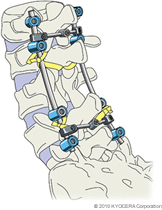 腰椎除圧固定術