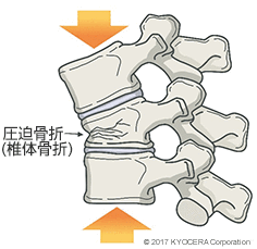 骨粗鬆症性圧迫骨折