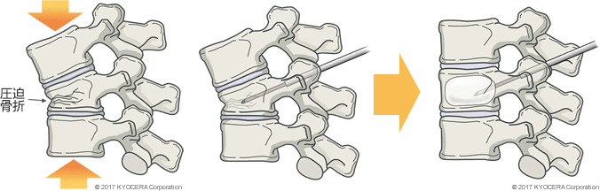 BKP（Baloon Kypoplasty：経皮的椎体形成術）