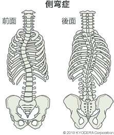 側弯症