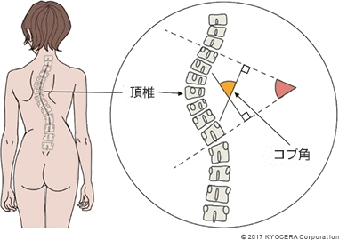 脊柱側弯症