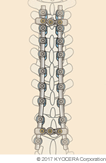 脊椎の多椎間固定術